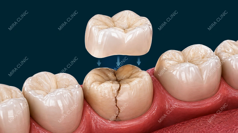 Cracked Back Tooth Need a Crown